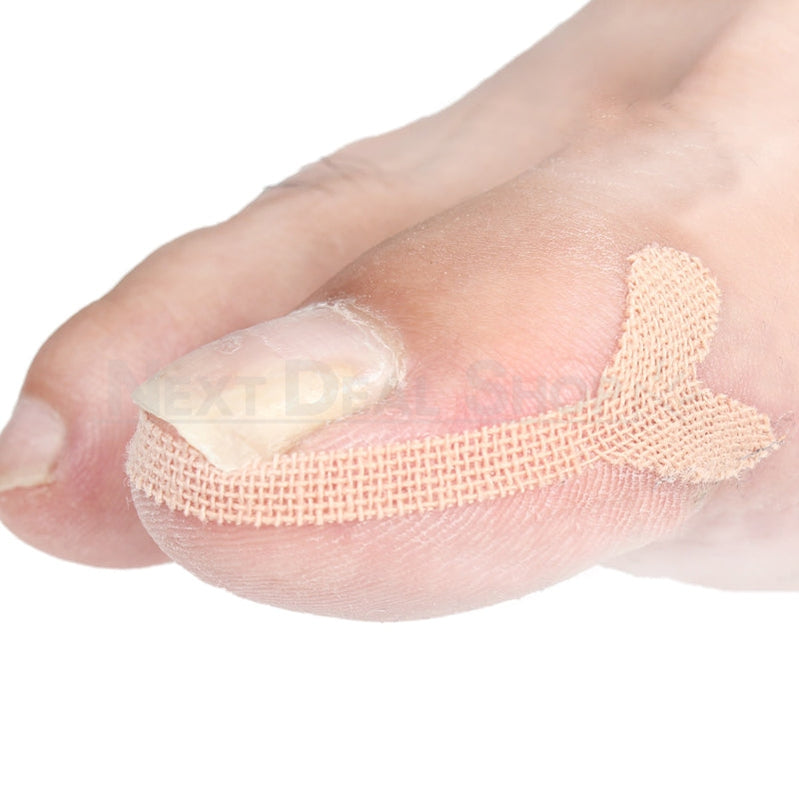 20 Pcs- Ingrown Nail Treatment Sticker