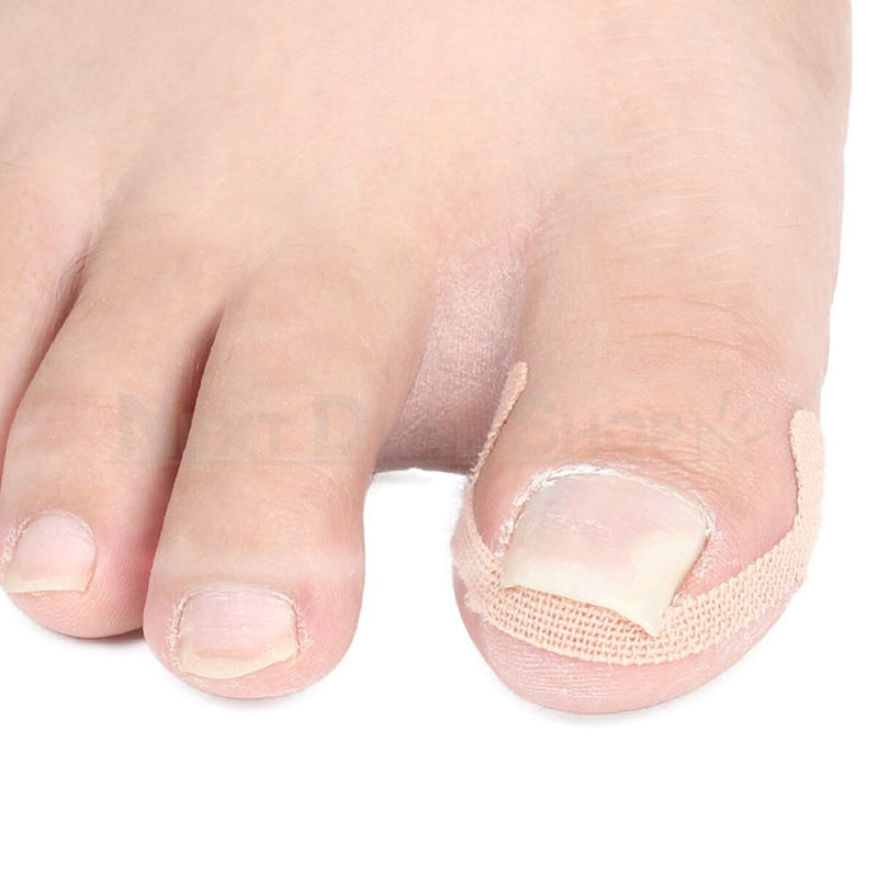 20 Pcs- Ingrown Nail Treatment Sticker